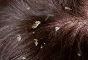 bed bugs in hair