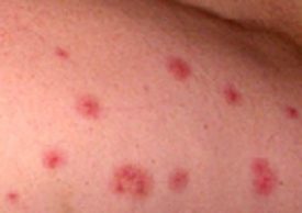 bug bites