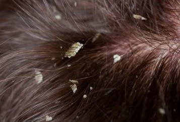 bedbugs on scalp